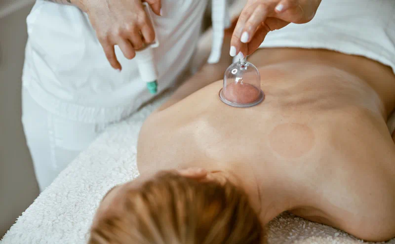 Cupping Therapy: An All-Natural Cure For Anxiety